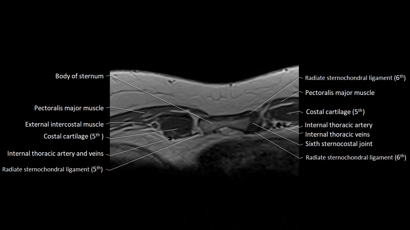 MRI sternum and sternoclavicular joint labeled axial anatomy image 31.webp